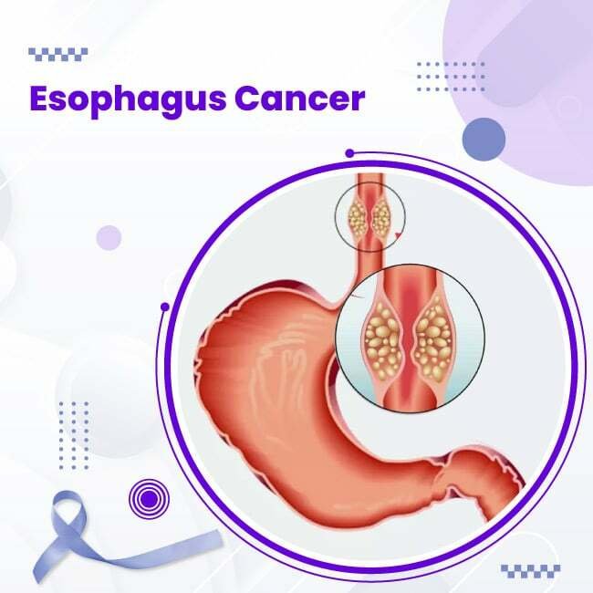 esophagus cancer xray