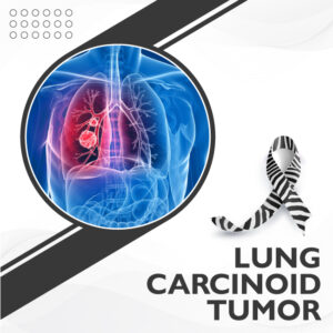 Lung Carcinoid Tumor | Uhapo