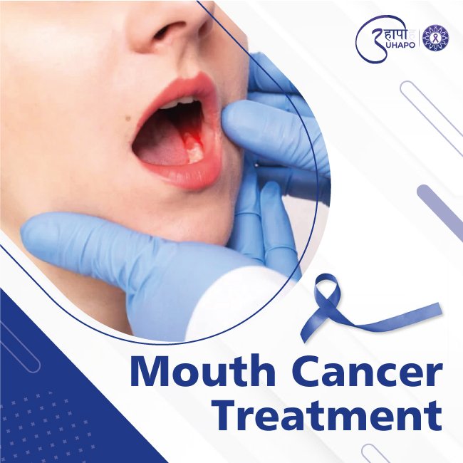 Mouth Cancer Treatment